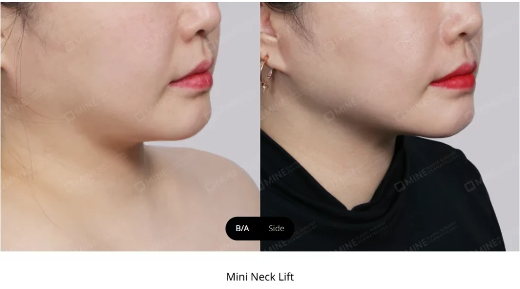 Side-profile comparison after a mini neck lift demonstrating improved jawline contouring with a smoother, more defined lower face and neck line.