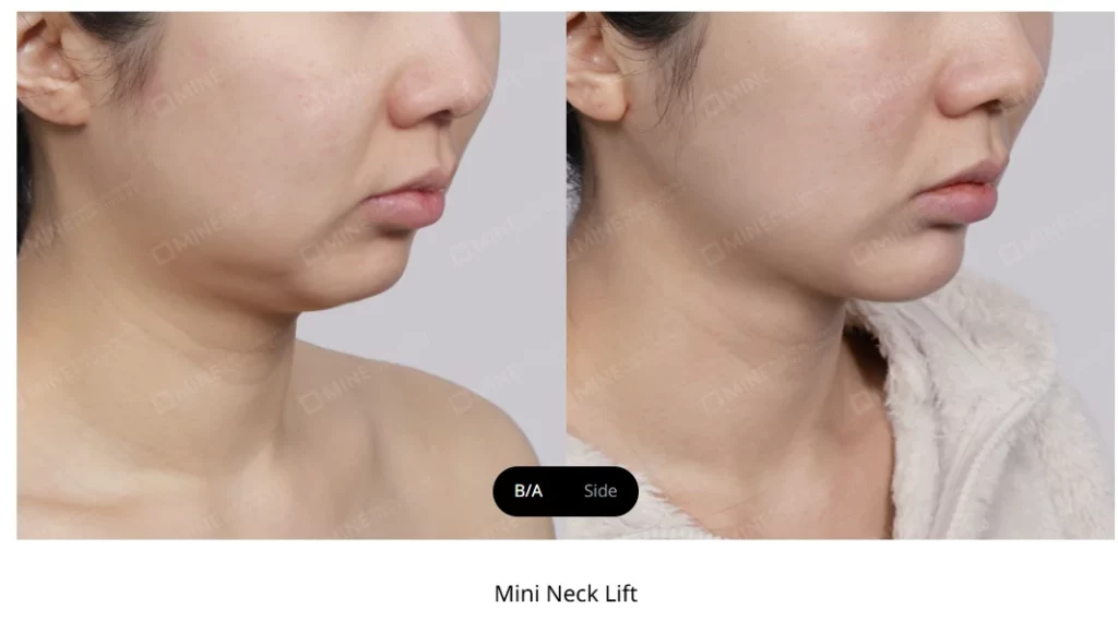 Jawline contouring surgery enhances facial structure and balance, but sagging jawline after contouring surgery is a relatively common concern that affects some patients. This post-surgical complication can be frustrating, especially when the goal was to achieve a more defined facial profile.