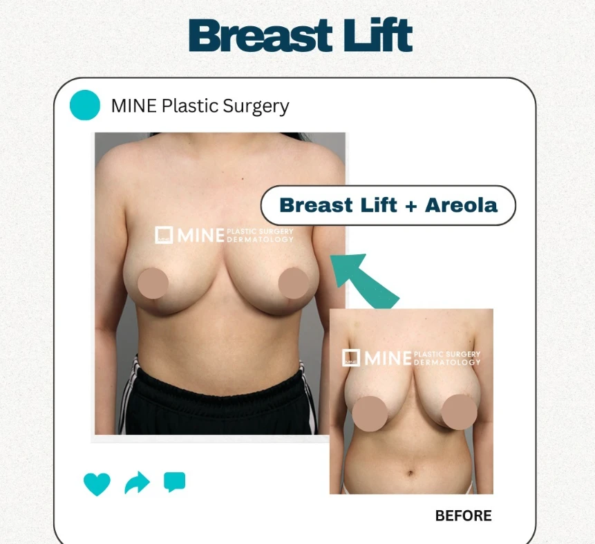 Breast lift surgery result showing a breast lift with areola correction, comparing before and after images with improved breast elevation, contour, and areola position.