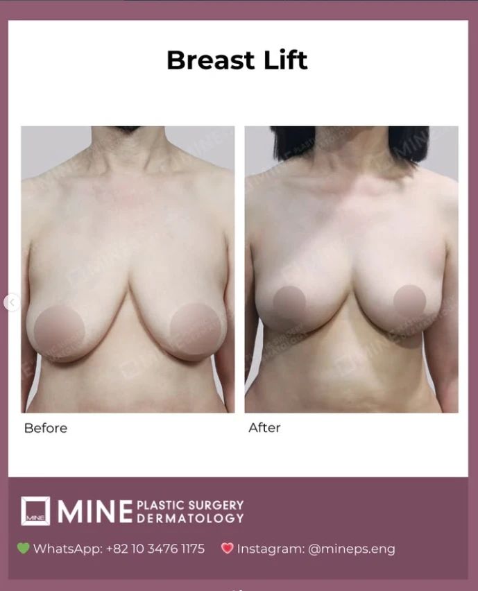 Breast lift surgery without implant before and after comparison showing improved breast position, shape, and firmness following a surgical breast lift procedure.