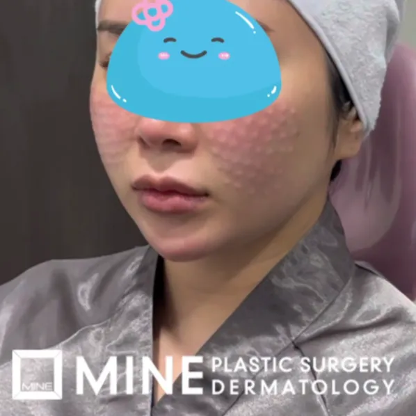 Female with rejuran embossing coming up after rejuran treatment at MINE Plastic Surgery. 