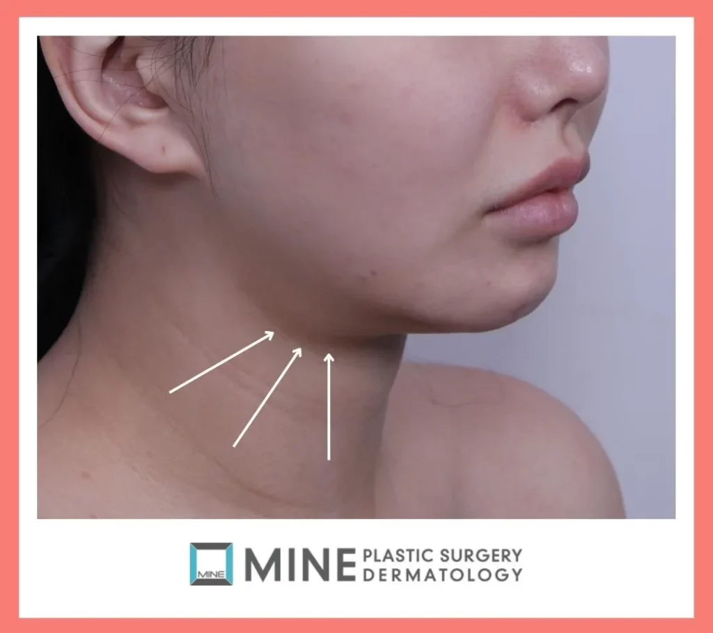 Side profile of the jawline and neck highlighting the surgical area during submandibular salivary gland reduction surgery recovery, showing reduced swelling under the chin.