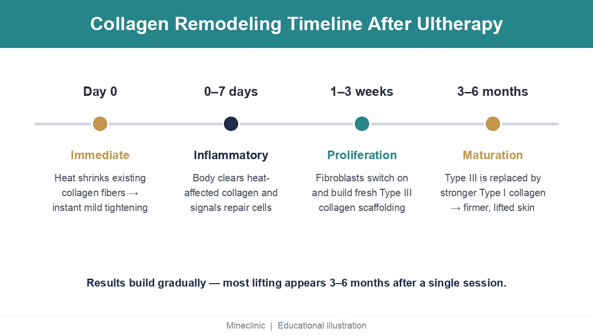 Timeline of collagen remodeling after Ultherapy from immediate contraction through maturation at three to six months