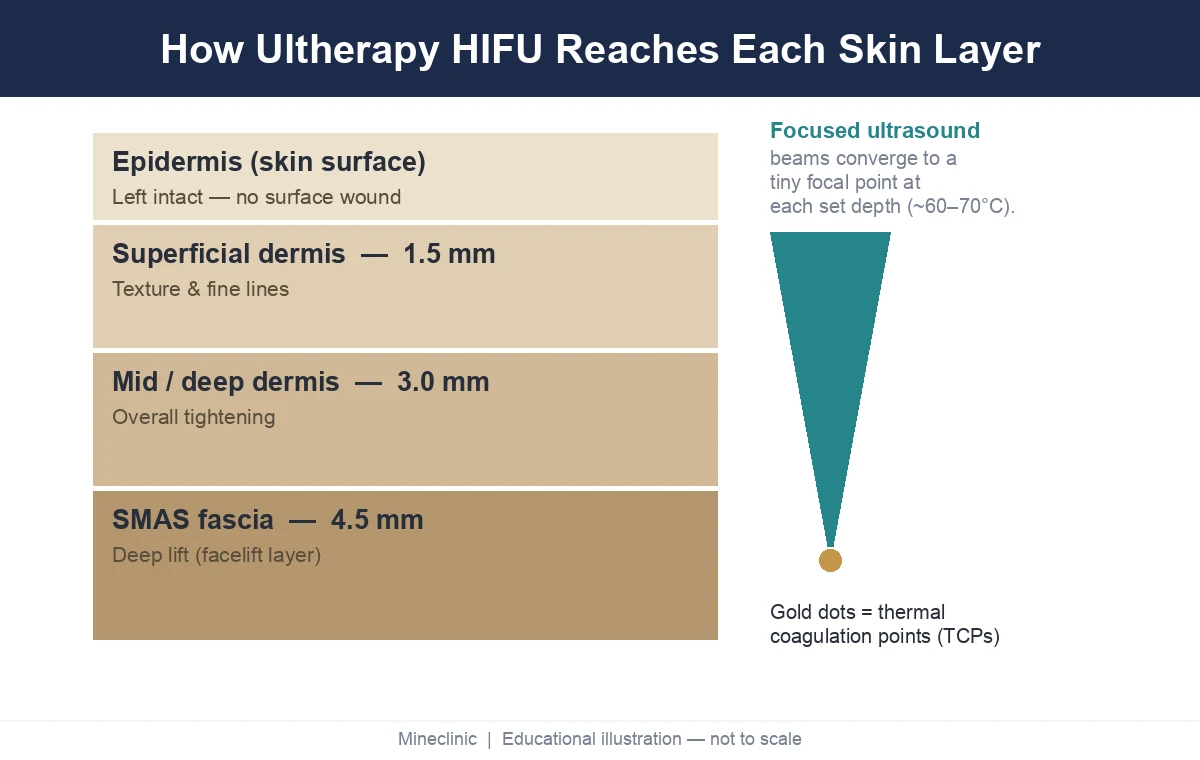 Diagram of Ultherapy HIFU microfocused ultrasound reaching dermis and SMAS at 1.5mm, 3.0mm, and 4.5mm depths