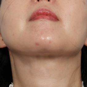 Horizontal scar 2 months after salivary gland removal, showing reduced swelling and improved jawline definition.