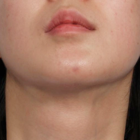 Neck profile 3 months post salivary gland removal with noticeably slimmer and more contoured lower face and hidden scar.