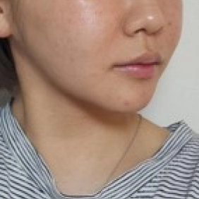 Two months after salivary gland removal with noticeable slimming of the lower face.