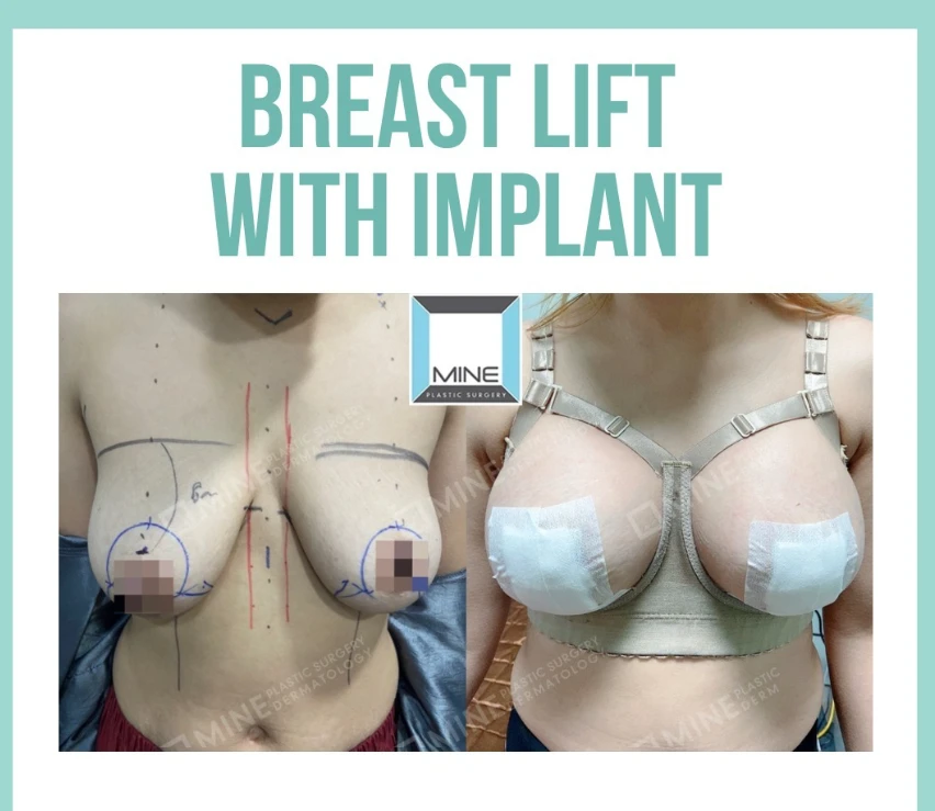 Breast lift surgery with implant before and after comparison, showing surgical markings before the procedure and postoperative recovery with implants and dressings, demonstrating improved breast position, volume, and contour after breast lift surgery.