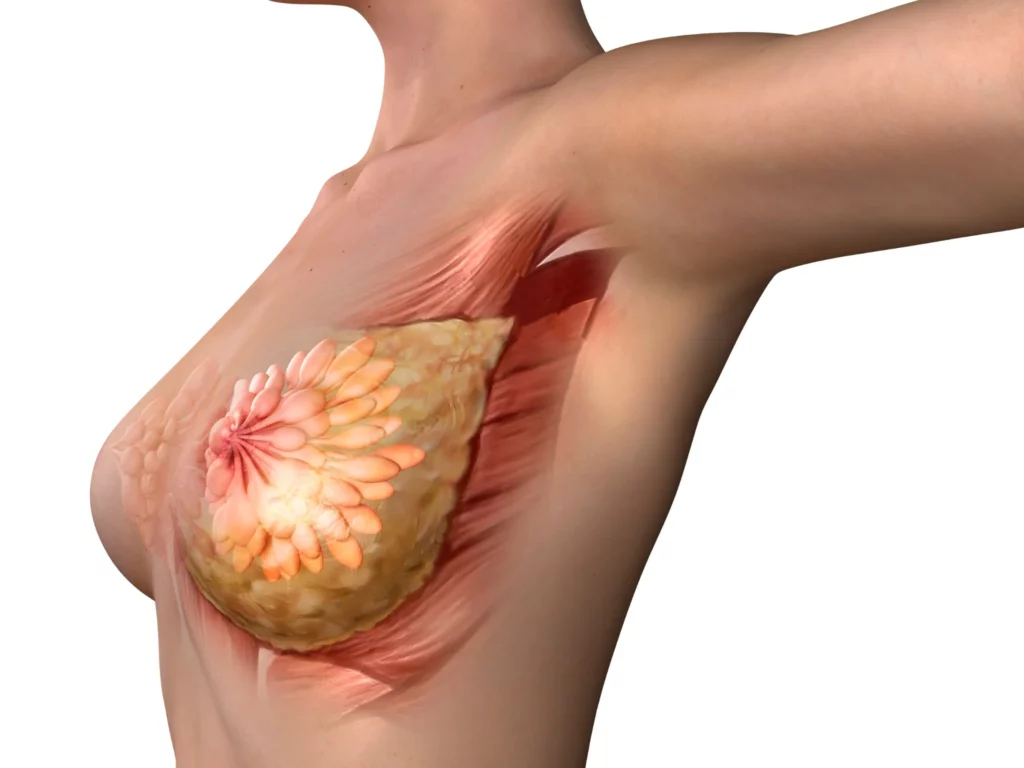 3D anatomical illustration of breast tissue and pectoral muscle from a side view, explaining structures reshaped and reduced during breast reduction surgery.