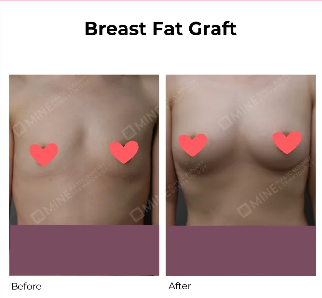 Breast fat transfer surgery before and after image showing changes in breast volume and contour following autologous fat grafting.