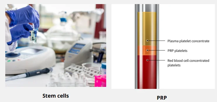 Breast fat transfer surgery image illustrating the role of stem cells and PRP in improving fat graft survival and postoperative outcomes.