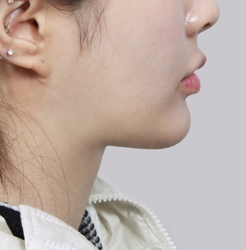 Profile view of a woman showing a defined jawline after salivary gland removal