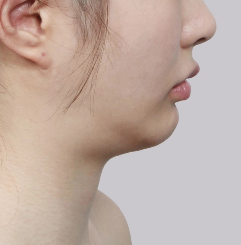Profile view of a woman with lower face fullness before salivary gland removal