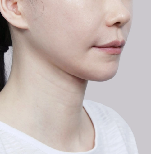 Side view of a woman showing a slimmer jawline after salivary gland removal.