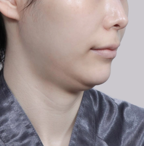 Side view of a woman with a bulky lower face before salivary gland removal.