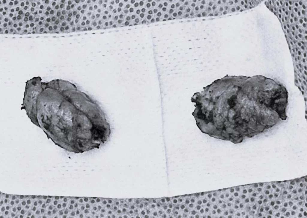 Actual saliva gland portion that is removed during salivary gland removal surgery because salivary gland liposuction does not work. 