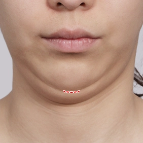 Close-up of chin and neck showing where the incision would be located for salivary gland removal and double chin surgery.