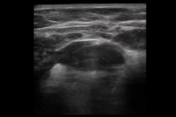 Ultrasound image of the submandibular area showing salivary gland before removal procedure.