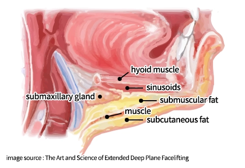 Anatomical illustration of the neck highlighting the submaxillary gland and surrounding tissues, used to explain salivary gland removal.