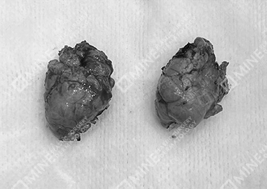 Salivary glands that were removed during salivary gland removal surgery, placed on medical gauze for documentation.