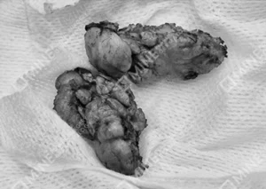 Large saliva gland tissues displayed post salivary gland removal surgery.