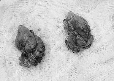 Two gland samples shown side by side that were removed after salivary gland removal procedure.