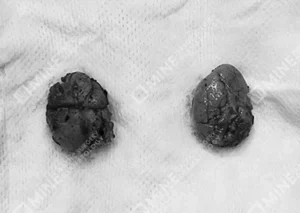 Symmetrical specimens laid out after successful salivary gland removal.