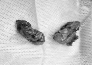 Compact tissues shown after salivary gland removal, placed on sterile cloth.