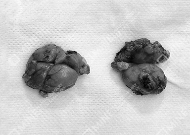 Smooth-textured glands documented after salivary gland removal.