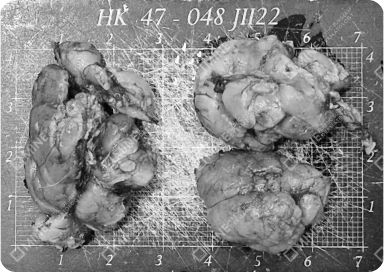 Multiple huge irregular glands displayed after salivary gland removal procedure.