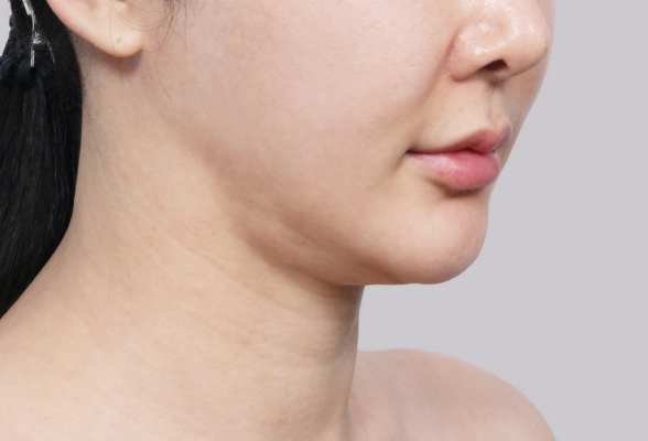 Close of lower jaw showing why this patient needed salivary gland removal.