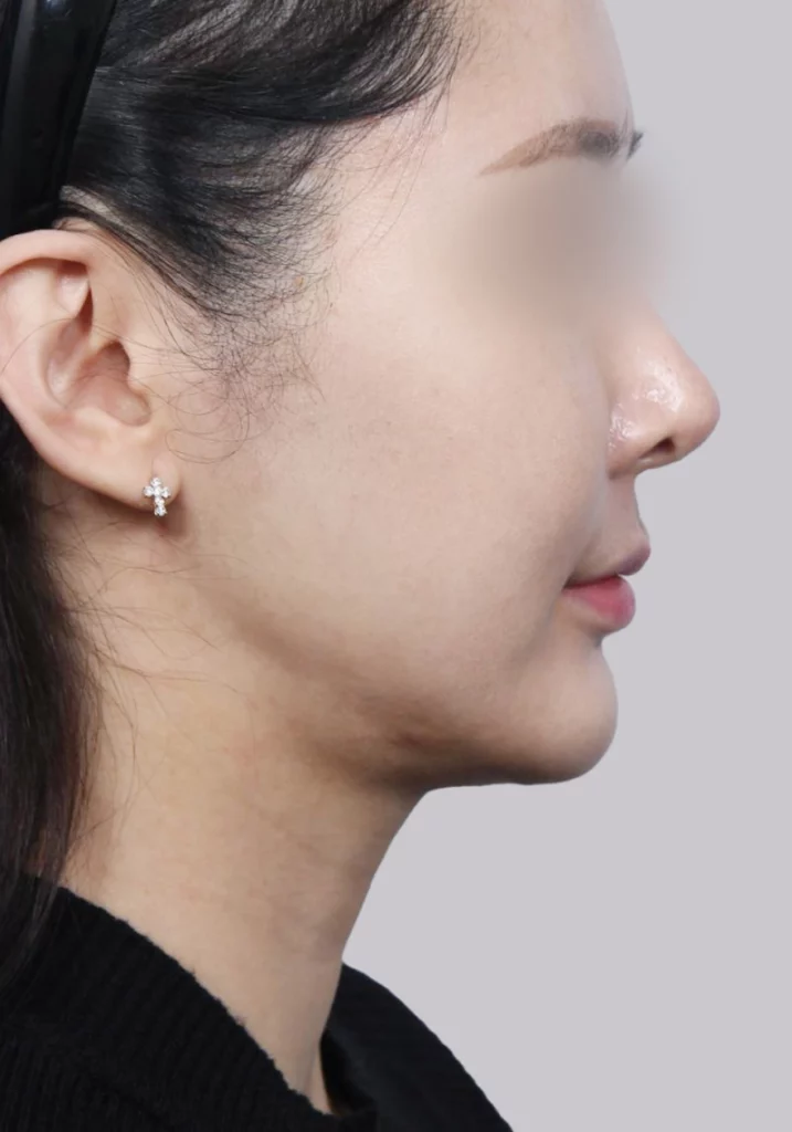 Female patient 1 before salivary gland removal.