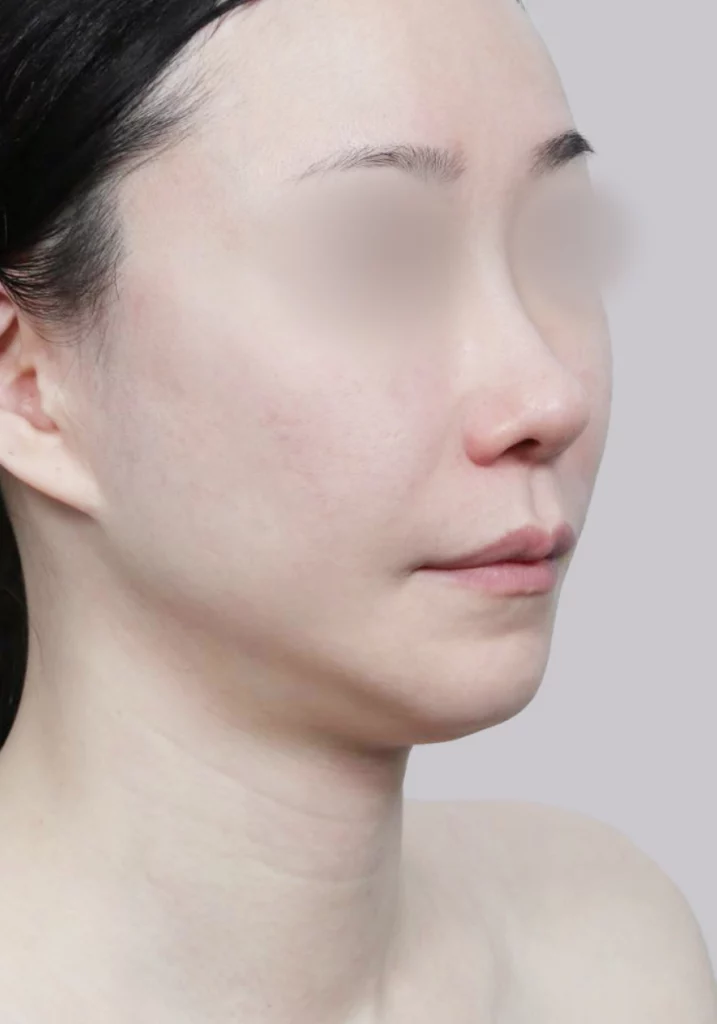 Female patient 3 45 degree angle view before salivary gland removal surgery.