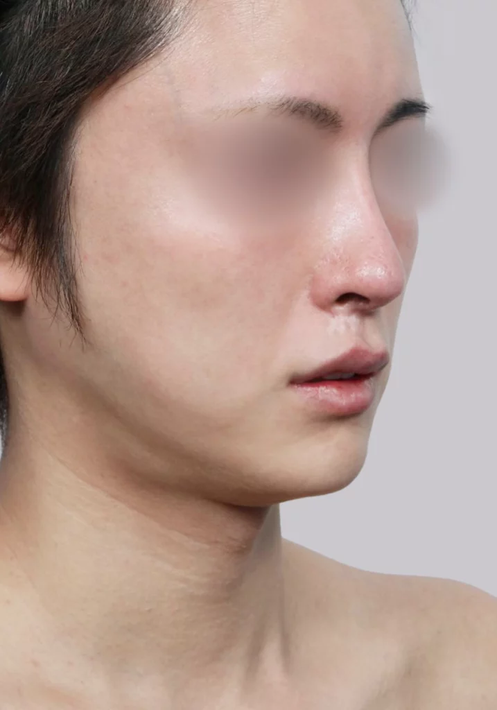 Male patient 45 degree angle view before salivary gland removal surgery.