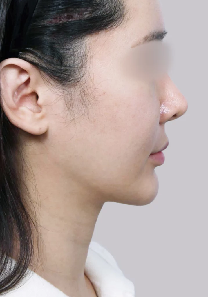 Female patient 1 after salivary gland removal.