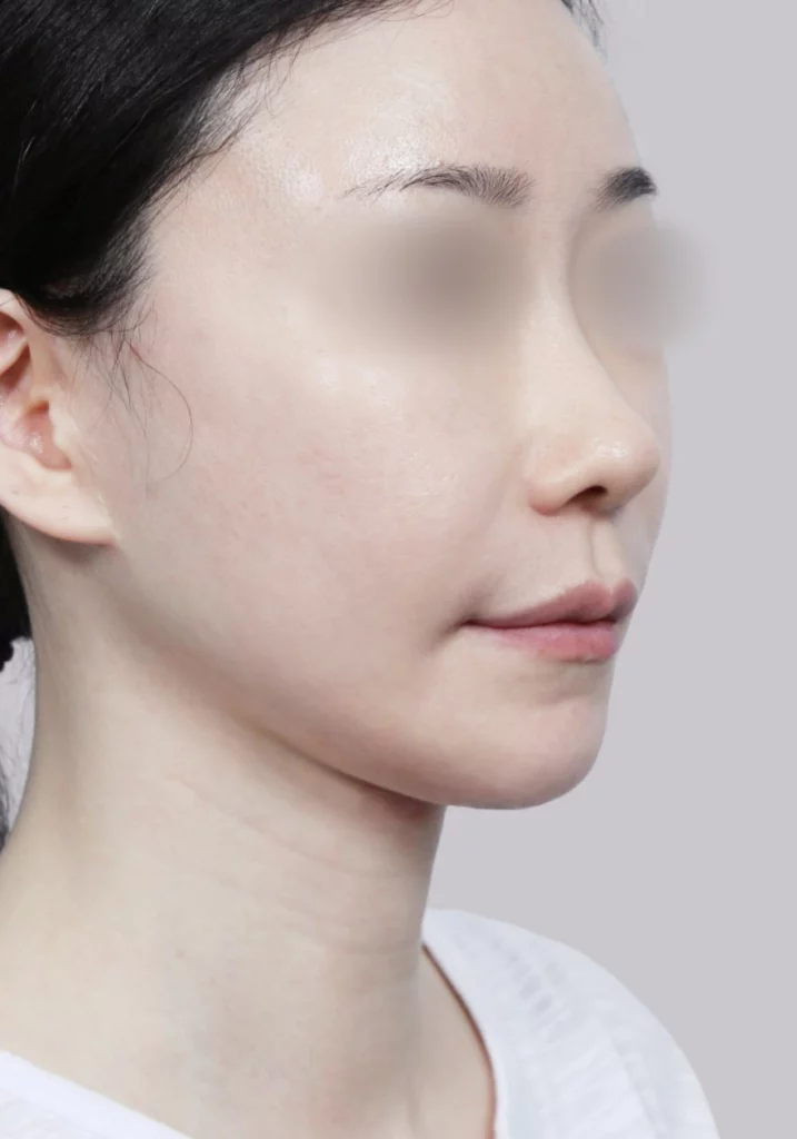 Female patient 3 after salivary gland removal and mini neck lift with sharper lifted jawline.