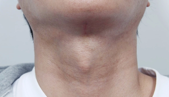 Patient left with vertical scar side effect after getting neck cosmetic surgery targeting salivary gland removal from a different clinic.