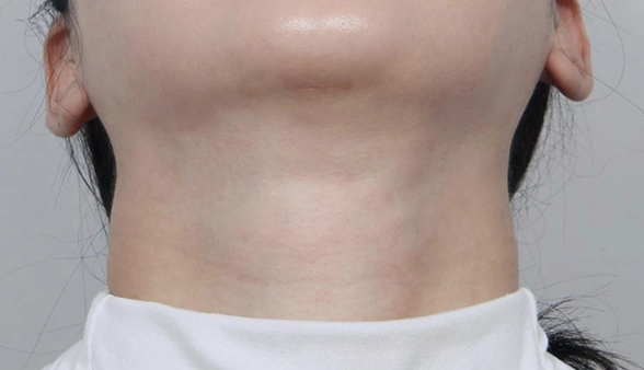 Patient who did surgery at MINE clinic left with hidden horizontal scar after salivary gland removal and double chin surgery.