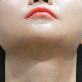 Scar result 4 months after salivary gland removal, highlighting a sharp and well-defined jawline and barely showing scar.