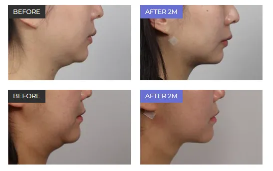 Before and after 2 months results of double chin fat removal surgery, showing a slimmer jawline and reduced fullness under the chin.