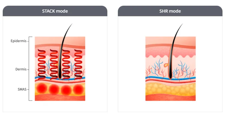Comparison of STACK mode and SHR mode in titanium lifting treatment, showing laser energy depth penetration from epidermis and dermis to SMAS layer for effective skin tightening.