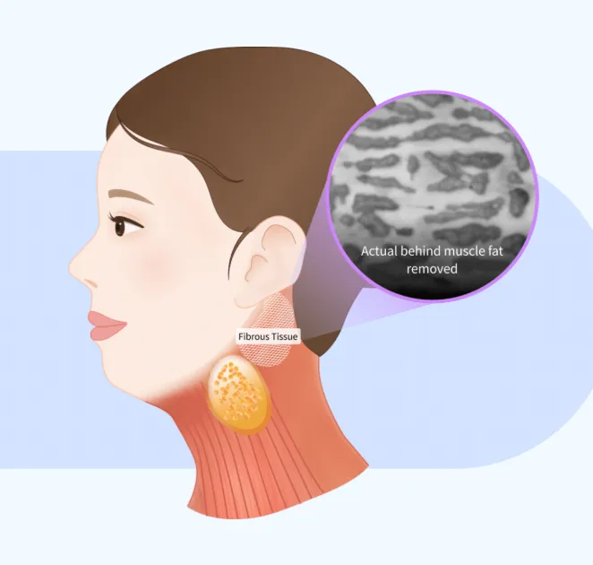 Image of fat located behind the muscle that is removed during mini neck lift and neck lift surgery.