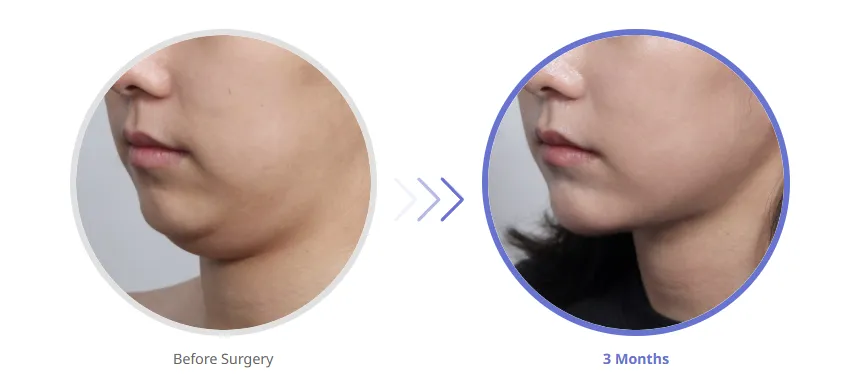 Before and after results of double chin fat removal surgery, showing a smoother jawline and improved chin contour after 3 months.
