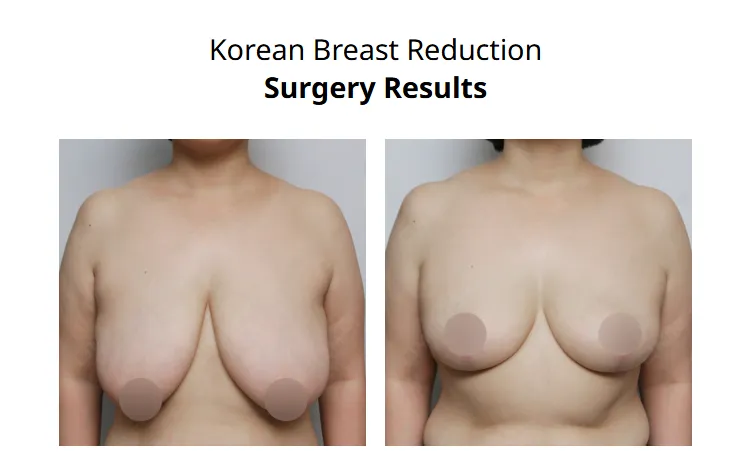 Before and after photos of Korean breast reduction surgery results, showing improved breast shape and minimized breast reduction scars.