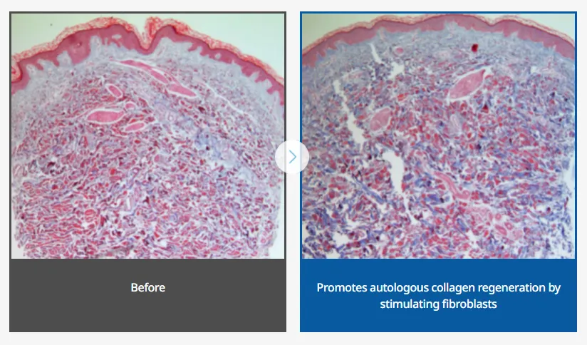 How the skin changes on cell level with Juvelook treatment.
