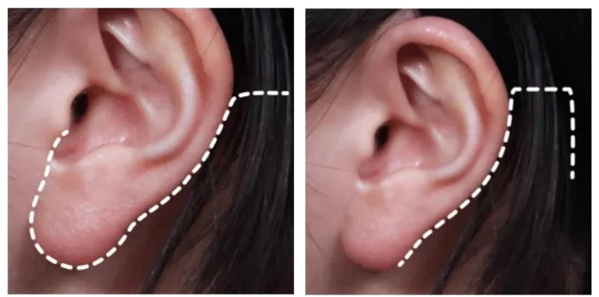 Comparison image showing ear incision lines used in neck lift and mini neck lift surgery, highlighting discreet behind-the-ear approach for minimal scarring.