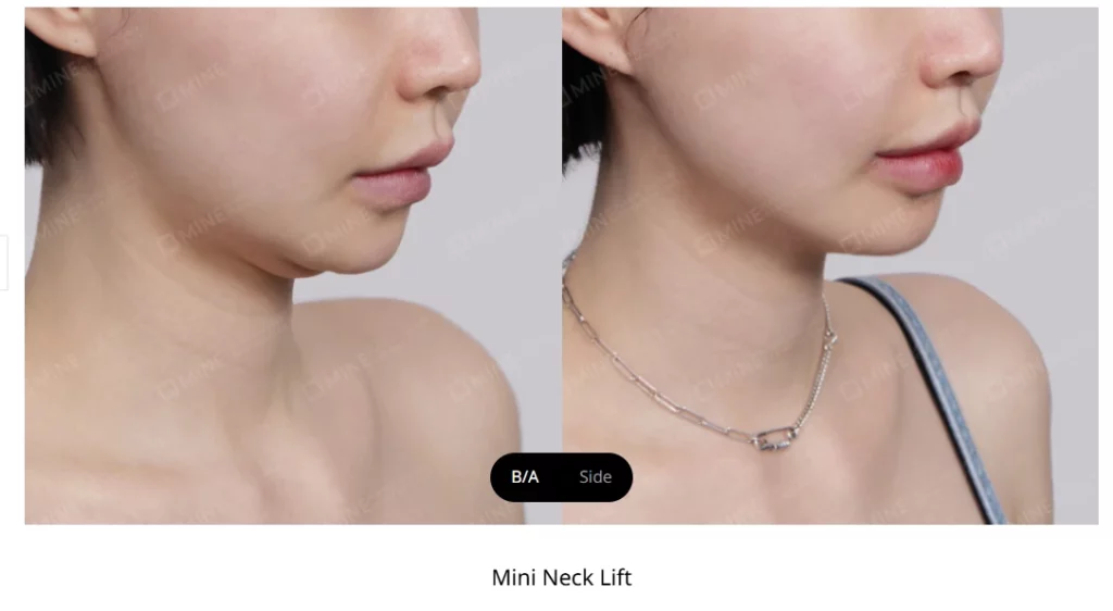 Side profile comparison image demonstrating results of neck lift and mini neck lift surgery, showing improved jawline definition and smoother neck contour.