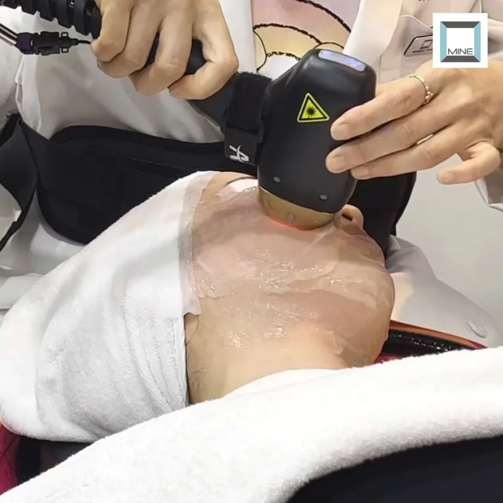Patient receiving titanium lifting treatment with a medical laser device applied to the face for skin tightening and rejuvenation.