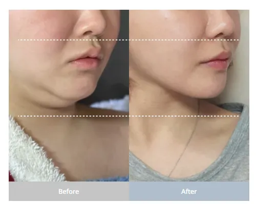 Before and after photos demonstrating Korean jawline contouring, reducing double chin and lifted jawline after mini neck lift surgery.