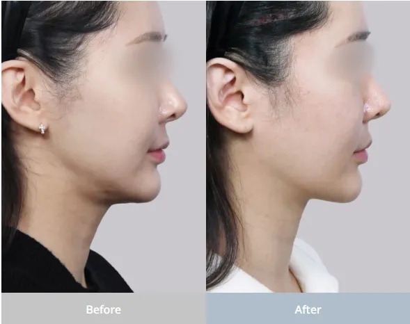 Saliva gland reduction before and after photo showing improved jawline definition and slimmer facial contour.